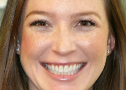Becca smiling with straight teeth after surgically accelerated orthodontics